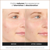 Azelaic Acid Acne Treatment Serum – Clarifying Face Booster for Blemishes & Uneven Skin Tone